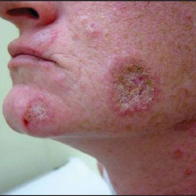 Discoid Lupus Erythematosus