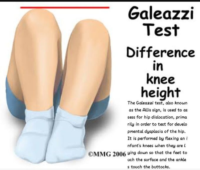 Galeazzi test