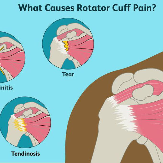 Causes of rotator cuff