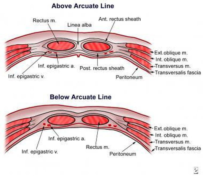 Rectus sheath hematoma - medizzy