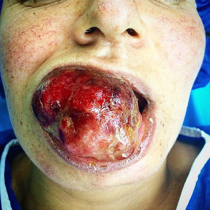 Peripheral giant-cell granuloma