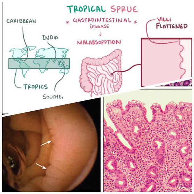Tropical Sprue