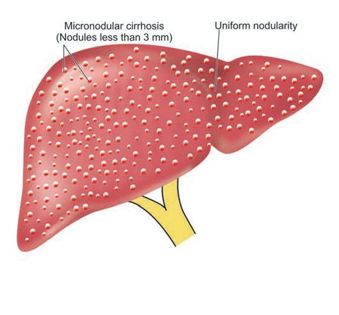 Alcoholic cirrhosis