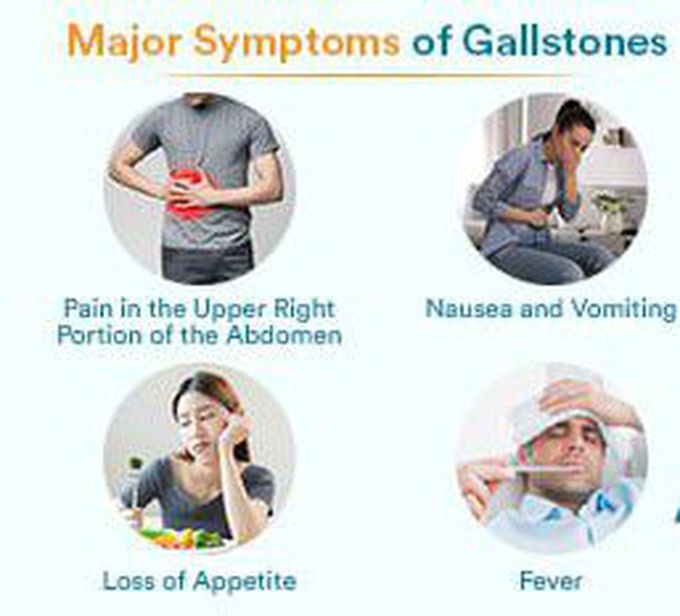 Symptoms of Cholelithiasis