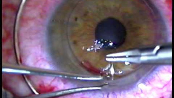 Cornea Transplant