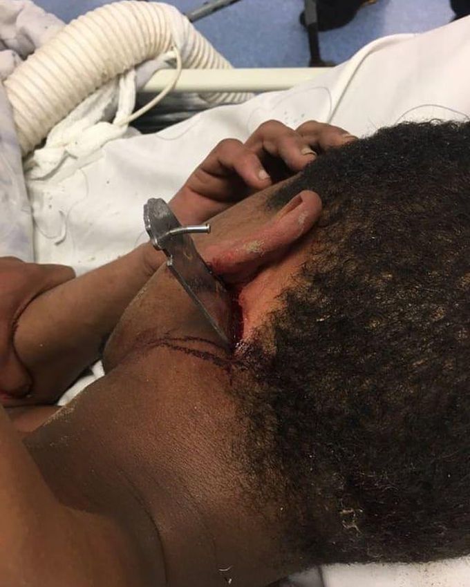 ⚠️ A case of a 17 year old male who walked into hospital with a knife stuck in his neck! 