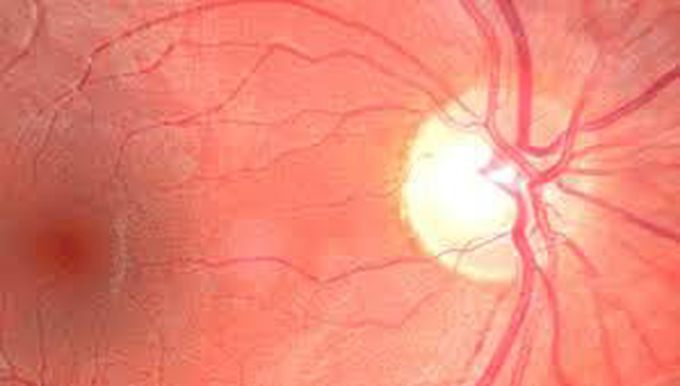 Cystoid macular edema