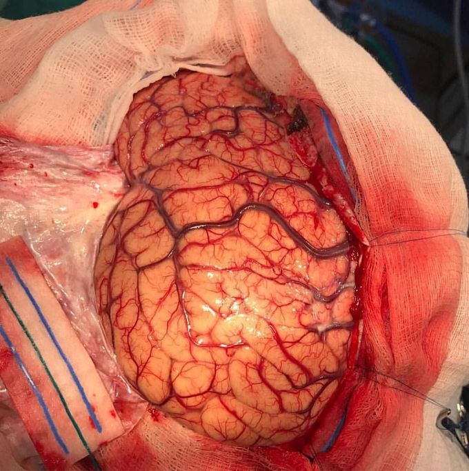 Neursurgery 