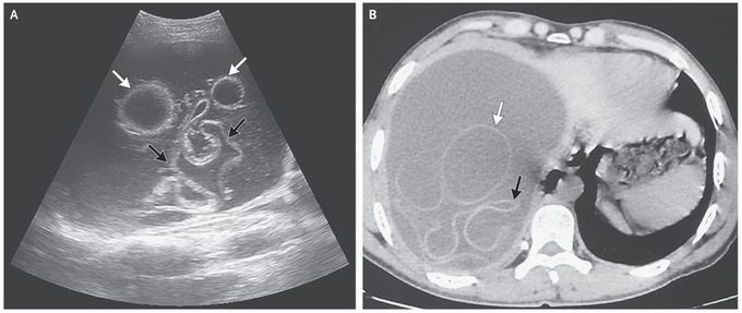 Echinococcal Cysts in the Liver