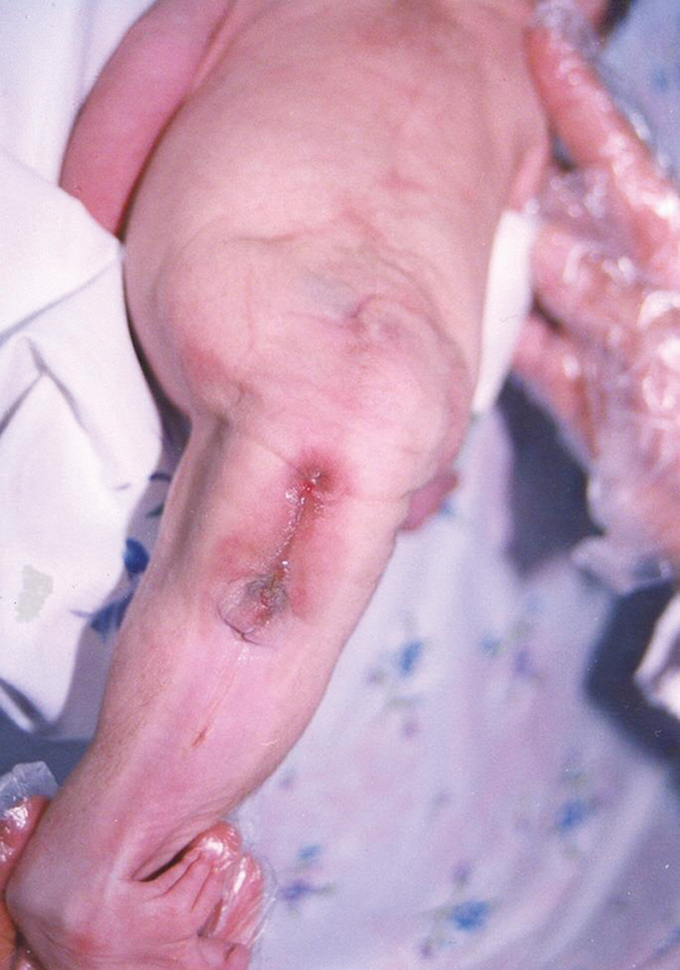 Mermaid Syndrome - A Rare Congenital Anomaly in Neonate