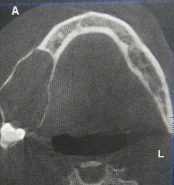 Unicystic Ameloblastoma