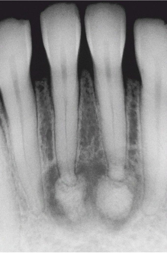 Periapical Cemento-Osseous Dysplasia.