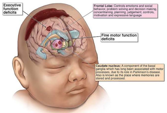 Hypoxic ischemic encephalopathy