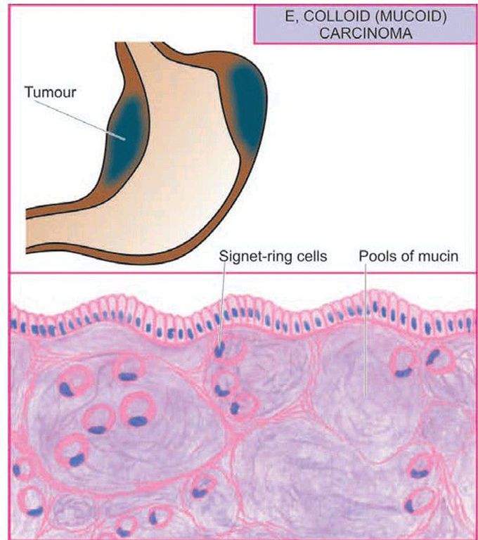 Gastric carcinoma