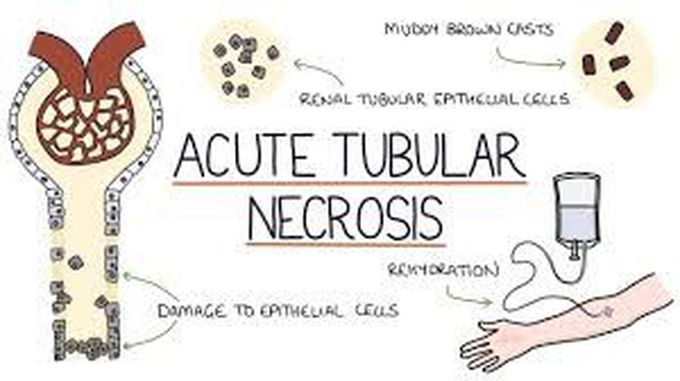 What is acute tubular necrosis?