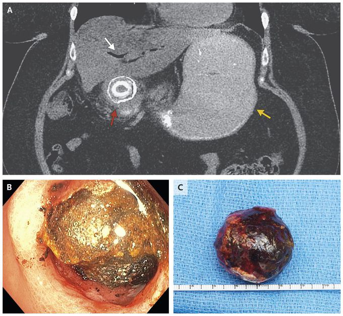 Bouveret’s Syndrome