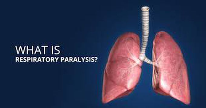 Respiratory paralysis
