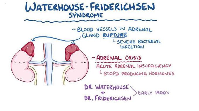 Waterhouse friderichsen syndrome