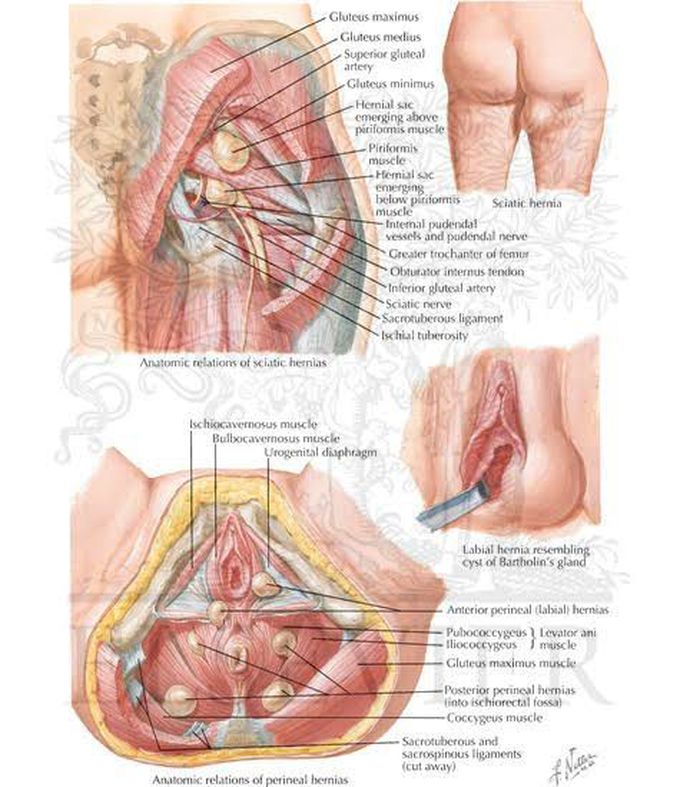 What do we call the hernia through the canal of Nuck?