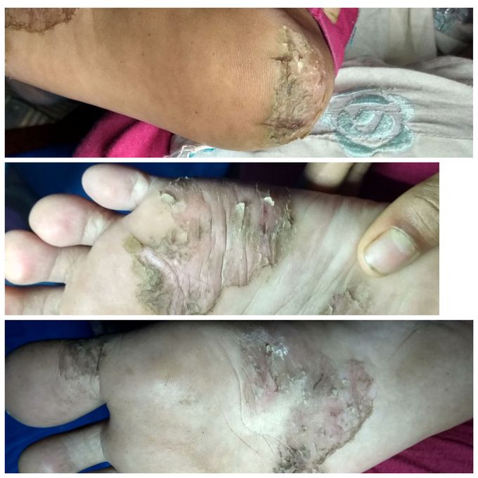 Skin Disorder..