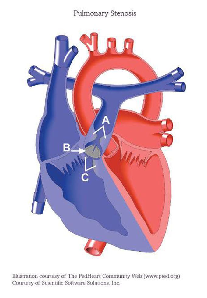 Pulmonary stenosis