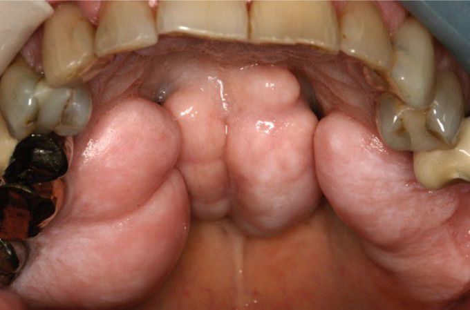 Palatal exostosis and torus palatinus