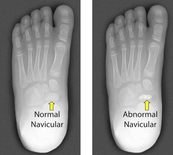 Kohler's Disease of the Tarsal Navicular