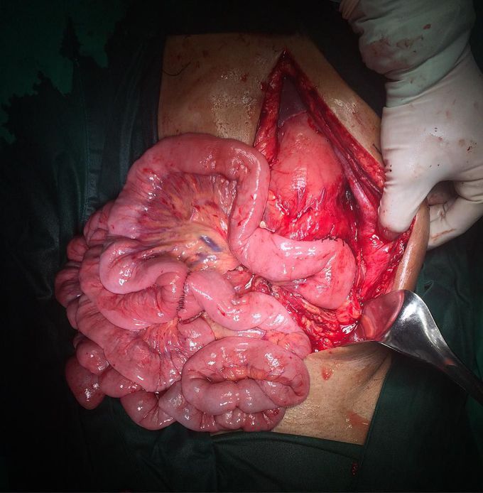 Roux-Y limb cystjejunostomy in Pancreatic pseudocyst (Mouiel and Crafa)