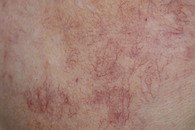 What are the treatments for spider nevus?
