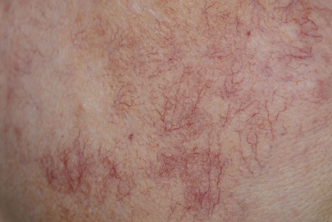 What are the treatments for spider nevus?