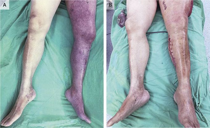 Phlegmasia Cerulea Dolens with Compartment Syndrome