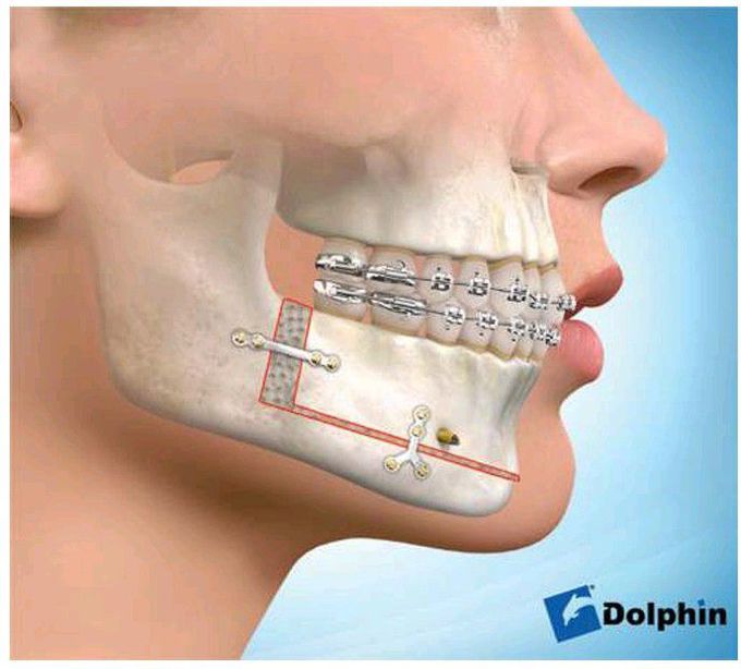 Total subapical osteotomy.