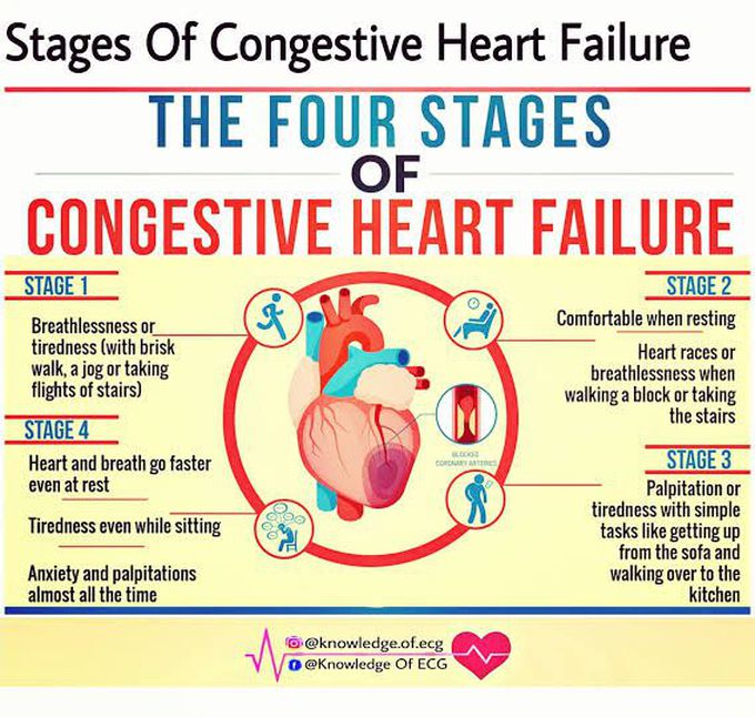 Stages of Congestive Heart Failure