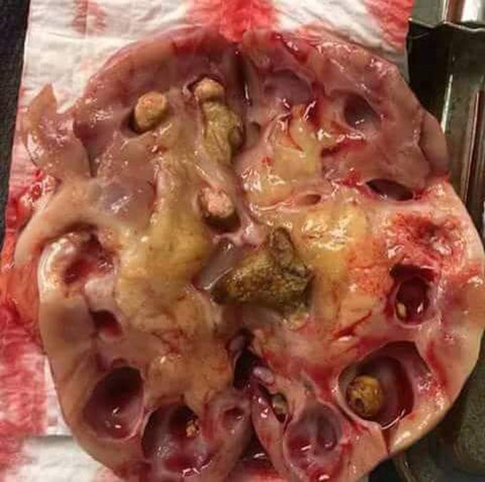 Pyelonephritis + Kidney stone