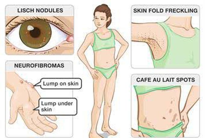 These are the symptoms of Neurofibromatosis syndrome