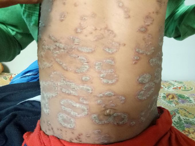 Psoriasis