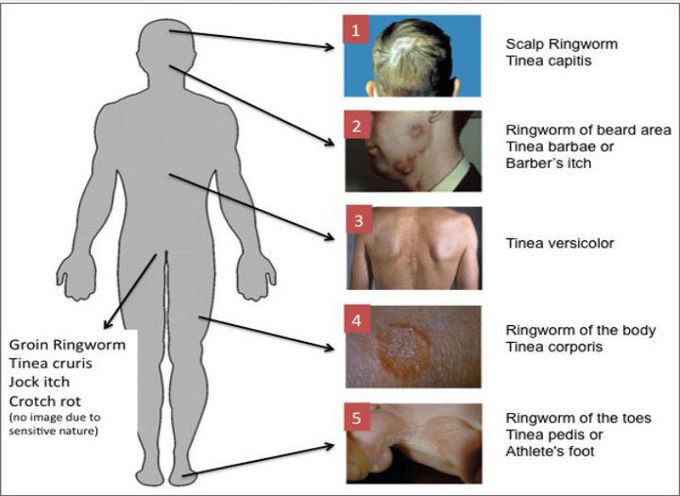 Major Fungal Diseases