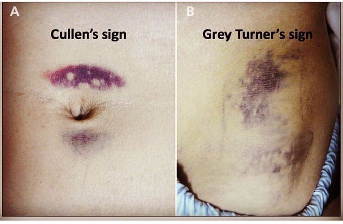 In which disease, these sign are seen????