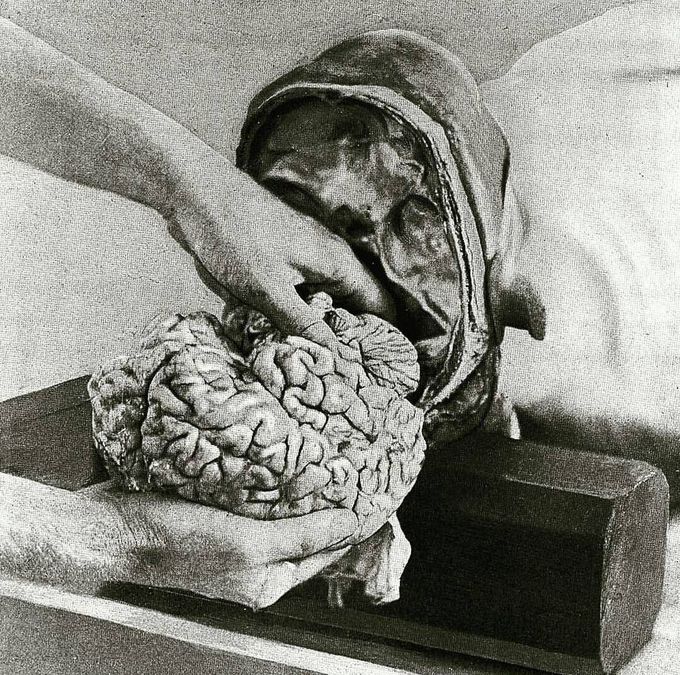 Brain removal