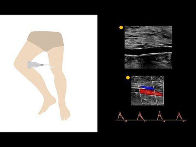 The protocol for performing arterial duplex of the lower limb