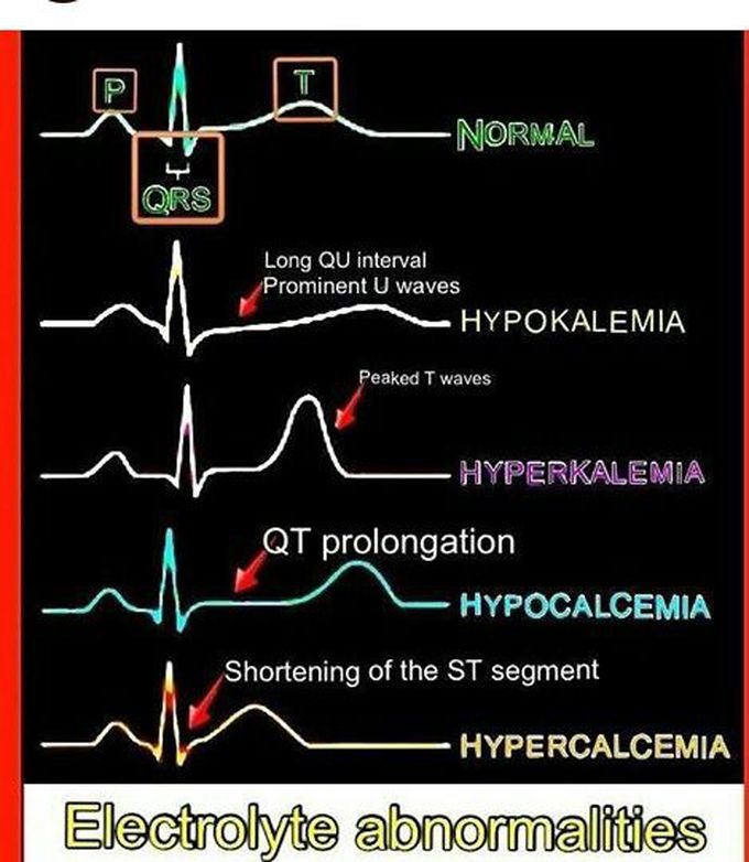 ECG changes due to electrolytes imbalance.
