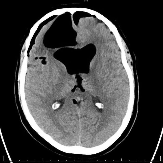Air in the brain!