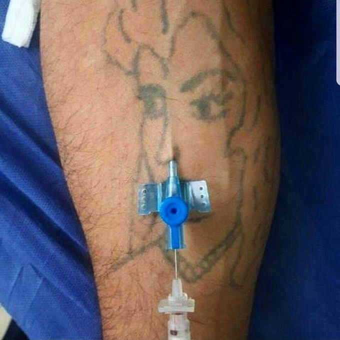 Intravenous (IV) cannulation