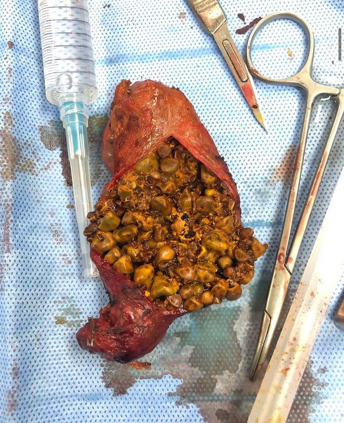 Gallbladder cholecystectomy