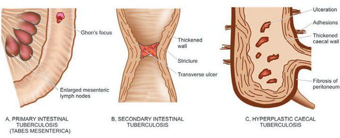 Intestinal tuberculosis