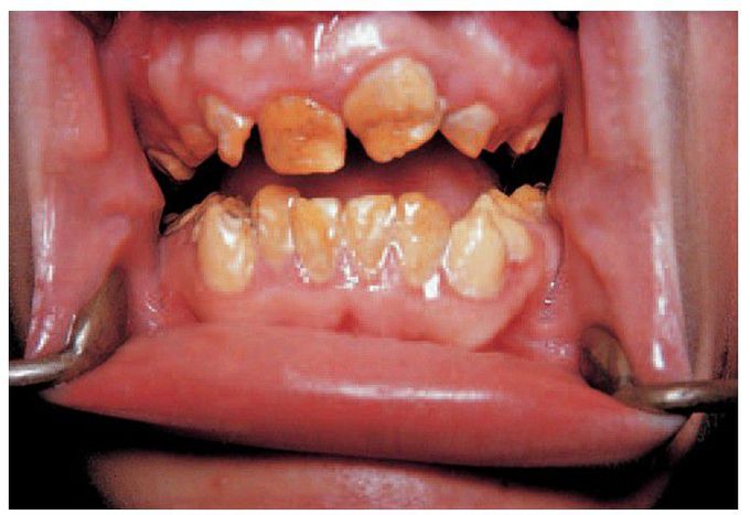 Amelogenesis imperfecta, hypocalcifi ed type