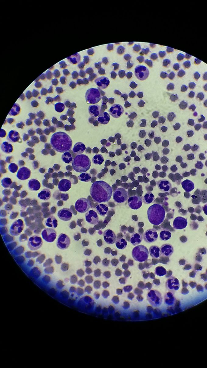 leukocytosis