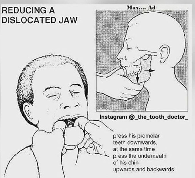 Reducing a dislocated jaw