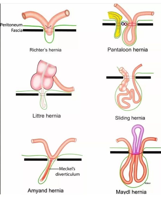 Types of Hernia