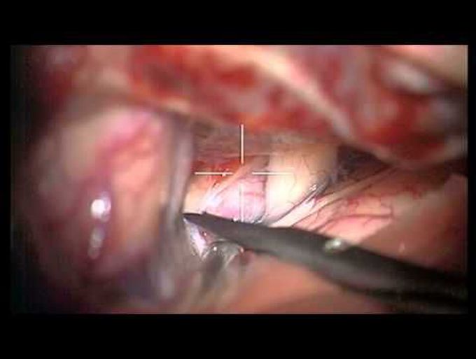 ACA aneurysm clipping using standard small fronto-pterional approach, Lazic clips